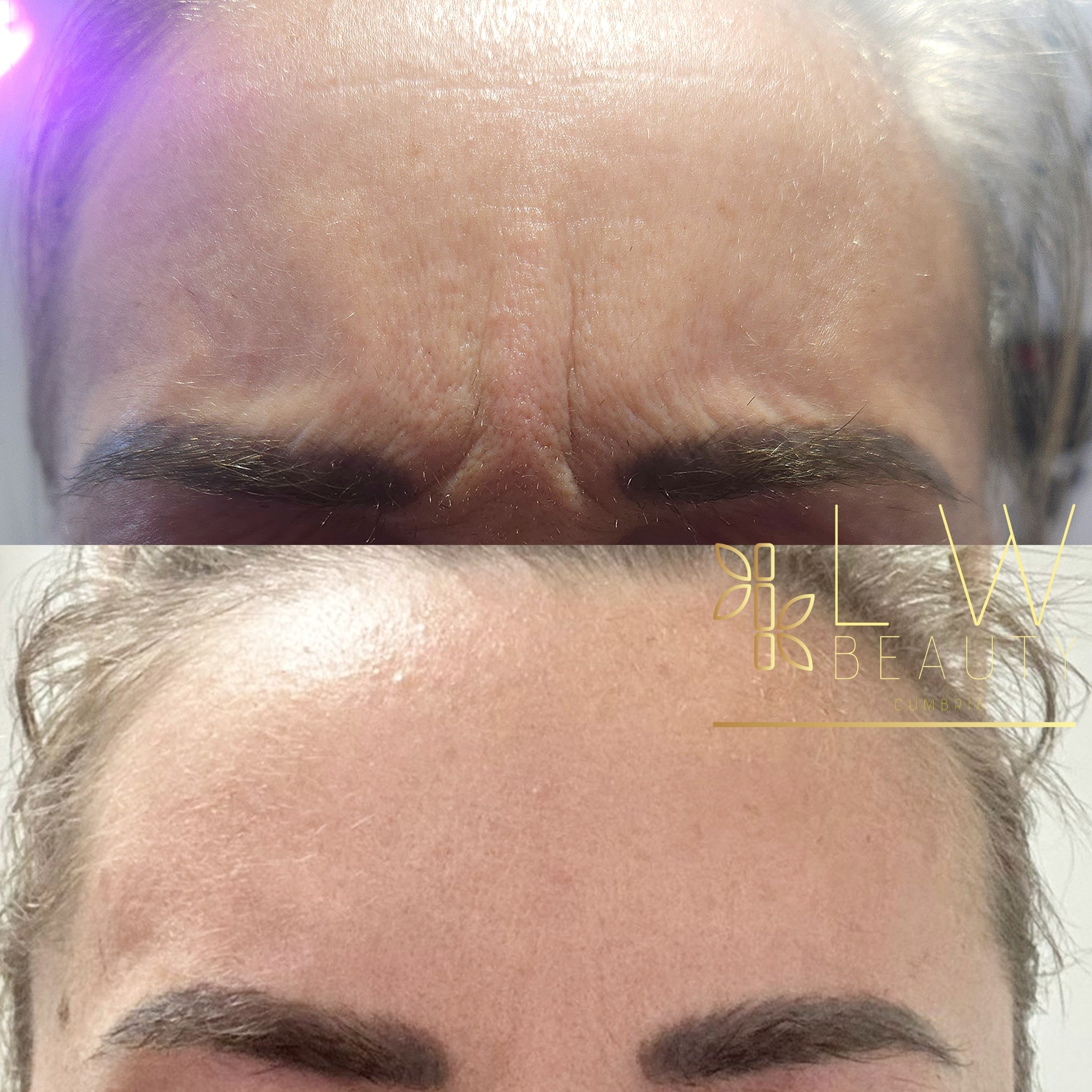 2 weeks post treatment 😌
Client is frowning in both photos 📸
This client originally had concerns regarding her dynamic lines and is now happy with her result 2 weeks post treatment 😍
To help decide what treatment is best for you -
Book in for an aesthetics consultation via my booking system or Message me 💜
#aesthetic #aestheticsclinic #aestheticspractitioner #aesthetics #cumbriasalon