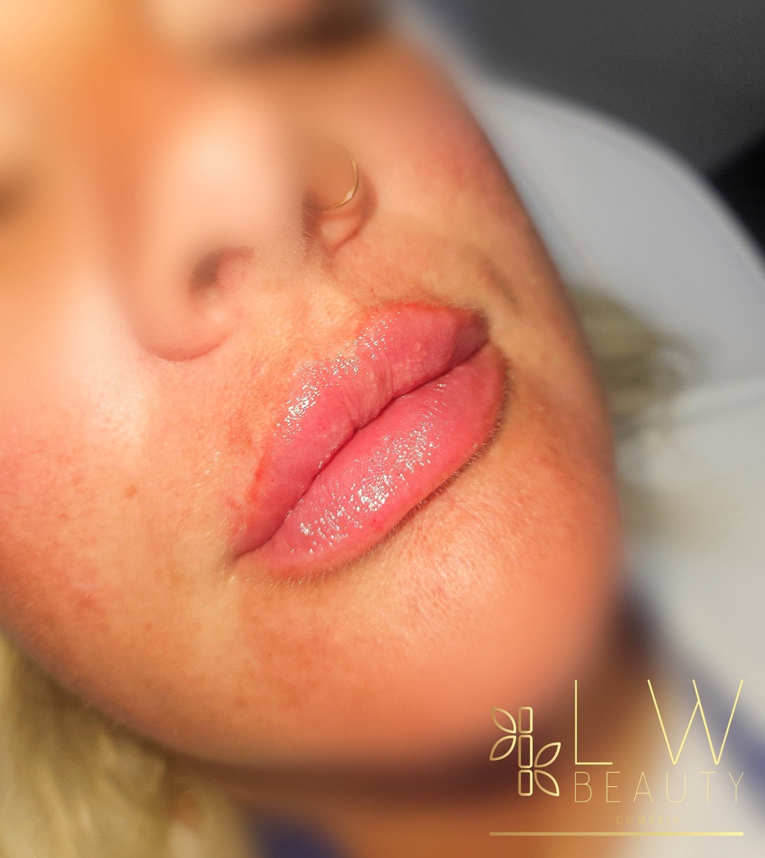 Flat side profile ✅️
Increased volume ✅️
Enhance cupids bow ✅️
1ml of dermal filler used to achieve these results 👏
0.5ml Dermal Filler - £100
1ml Dermal Filler - £130
Message me to book or via the Book Now button on my page 💜
#lwbeautycumbria #dermalfiller #lipfiller #aesthetic #aestheticsclinic #aestheticspractitioner #cumbriasalon #beautysalon #beautytherapist #aestheticstreatments #advancedaestheticspractitioner