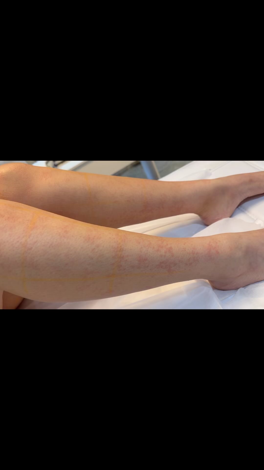 Royal Beauty Laser ~ little highlights of what I do โจ
-
-
-
#laserhairreduction #beautytreatment #microdermabrasion #skincare #skinstitut #selfcare #momoreshaving #ditchtherazor #lasertreatmentclinic