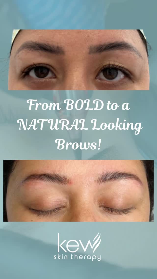 With the latest tattooing technology and improved pigments, we can now achieve more defined, natural-looking brows than ever before.
Whether you're enhancing your natural brows or transforming previously bold microblading into a softer, more natural look—we’ve got you covered.😊
BOOK NOW!
https://www.kewskintherapy.com.au/
Kew Skin Therapy
📍174 High Street, Kew, VIC 3101
📞(03) 9853 4544
📞0481 299 810
@highlights @followers
#KewSkinTherapy
#BrowTattoo #NaturalBrows #BrowEnhancement #MicrobladingCorrection #CosmeticTattoo #BrowTransformation #FlawlessBrows #BrowGoals #SkinClinicMelbourne