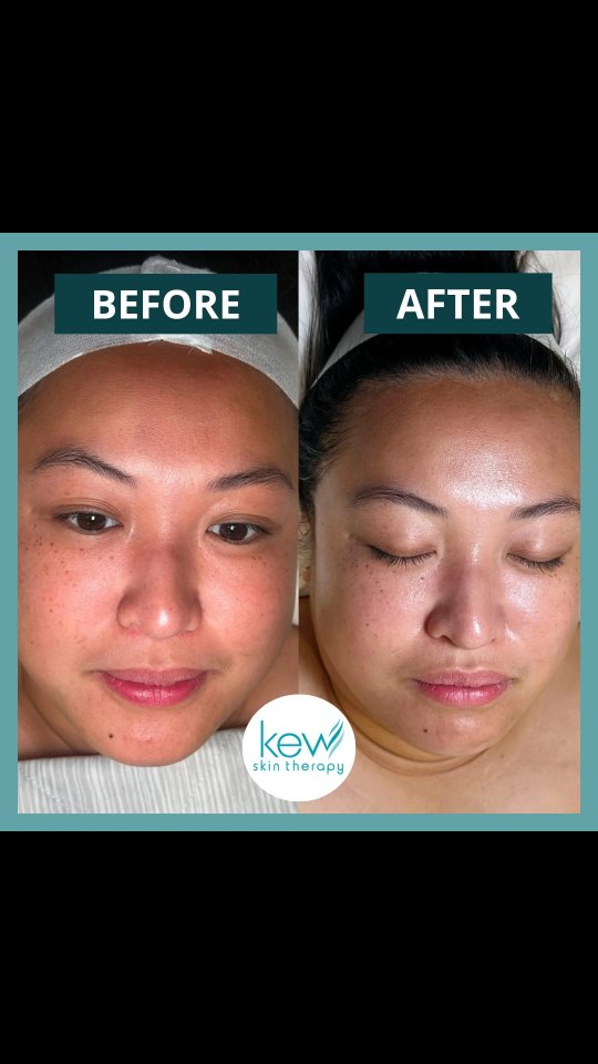 Glow up every month! ✨
Regular facials keep your skin clear, hydrated, and radiant while boosting relaxation and self-care.
Facials can also target breakouts and calm irritations leaving your skin healthy and glowing. ️
Take advantage of our $99 KST Signature Facial on TUESDAYS to THURSDAYS!
BOOK NOW!
https://www.kewskintherapy.com.au/
Kew Skin Therapy
📍174 High Street, Kew, VIC 3101
📞(03) 9853 4544
#Highlights
#Kewskintherapy #99facial #skinclinic #skinscience #melbourne #kew #hawthorne #balwyn #toorak #OCosmedics #ClearSkinJourney #HealthyGlow #HealthySkin #MonthlyFacials #SkinCareRoutine